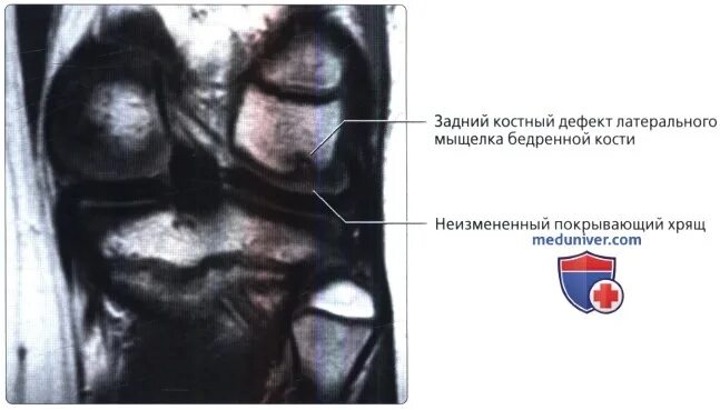 Хондромаляция медиального мыщелка бедренной кости мрт. Хондромаляция мыщелка бедренной кости на мрт. Дефект суставного хряща внутреннего мыщелка бедренной кости что это.