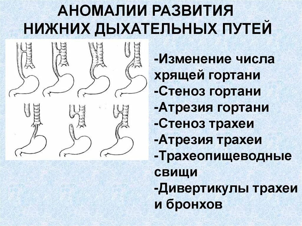 Аномалии развития называются. Аномалии развития органов дыхания. Пороки развития дыхательной системы. Аномалии развития дыхательной системы человека. Аномалии развития дыхательной системы анатомия.