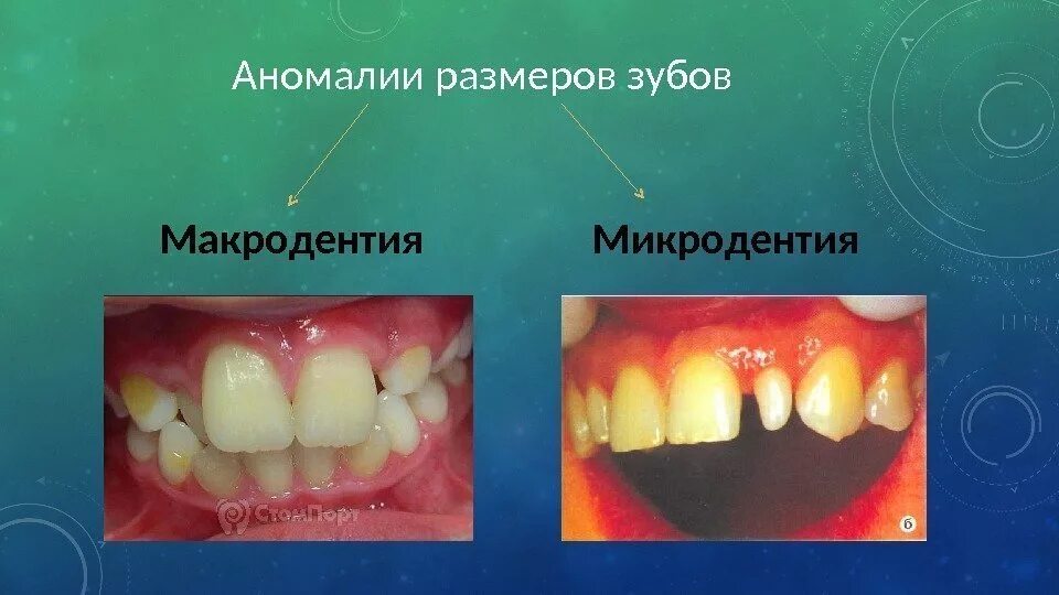 Аномалия 2 степени. Аномалии структуры твердых тканей зубов. Аномалии количества зубов. Аномалии размеров и формы зубов.