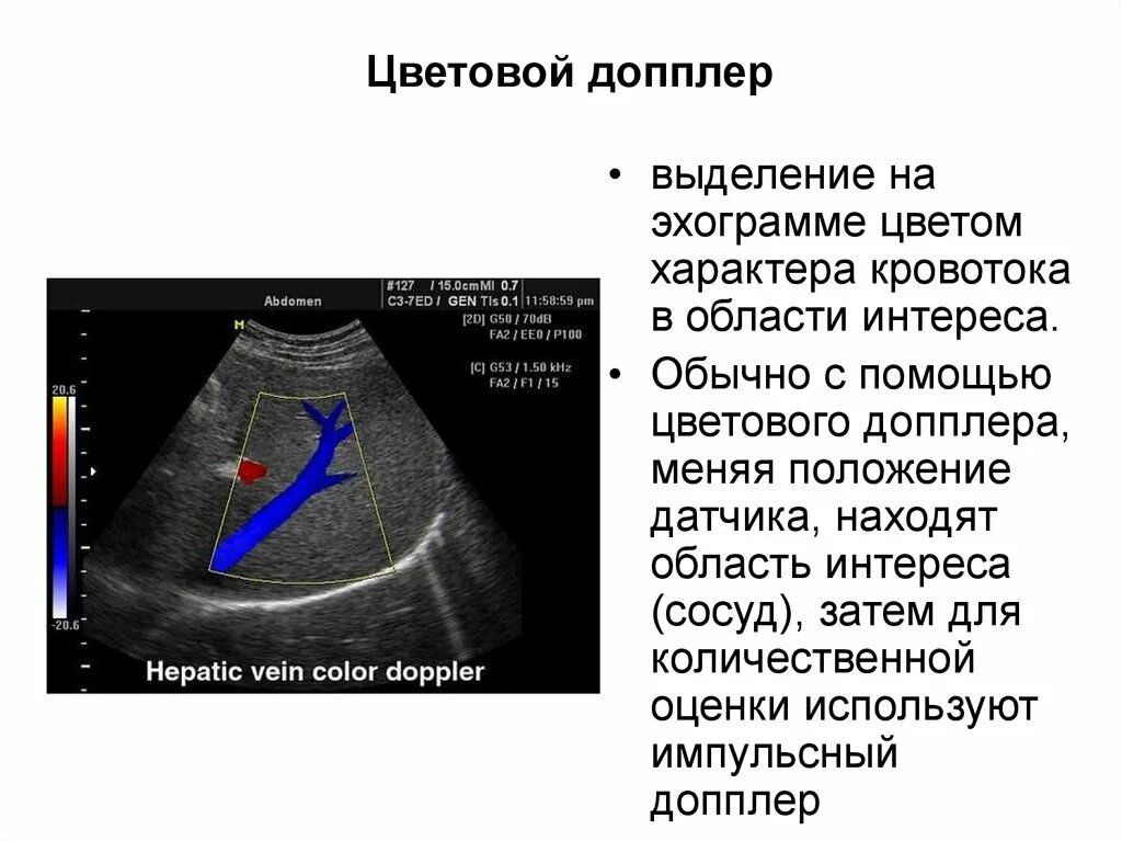 Что определяет доплер. Цветовой допплер. Эффект допплера в УЗИ. D) импульсный допплер.