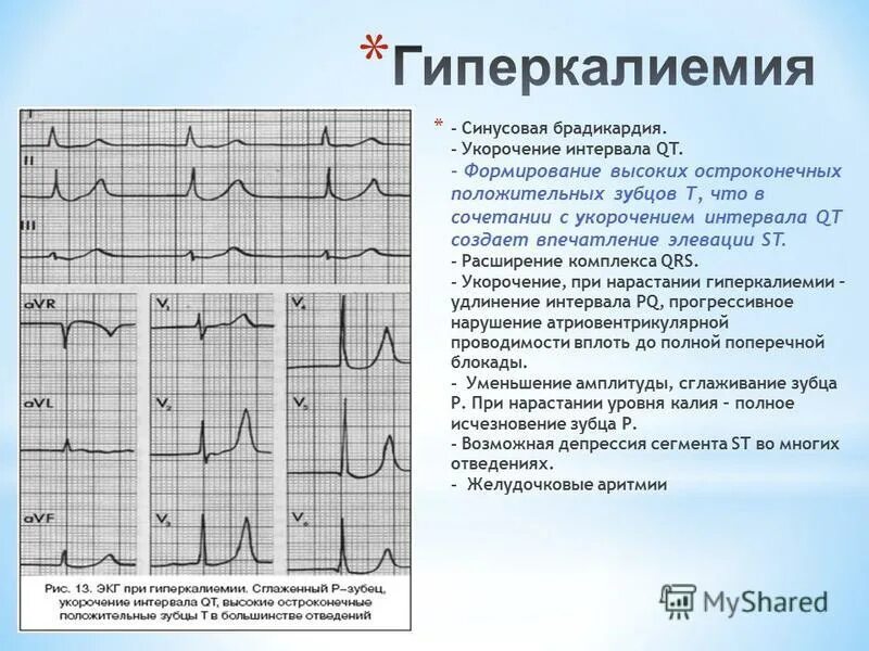 Удлинение комплекса qrs. Синусовая брадикардия на экг 25 мм. удлиненный комплекс st на экг. экг зубец т v 1. уменьшение комплекса qrs на экг.