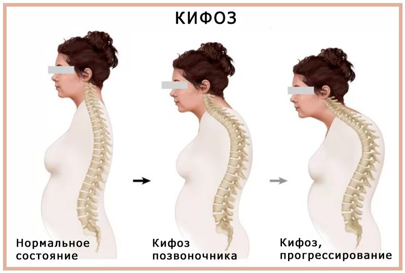Гиперкифоз грудного отдела. Кифоз грудного отдела позвоночника. Круглая спина. Грудной гиперкифоз что это. Лордоз шейного отдела отдела.