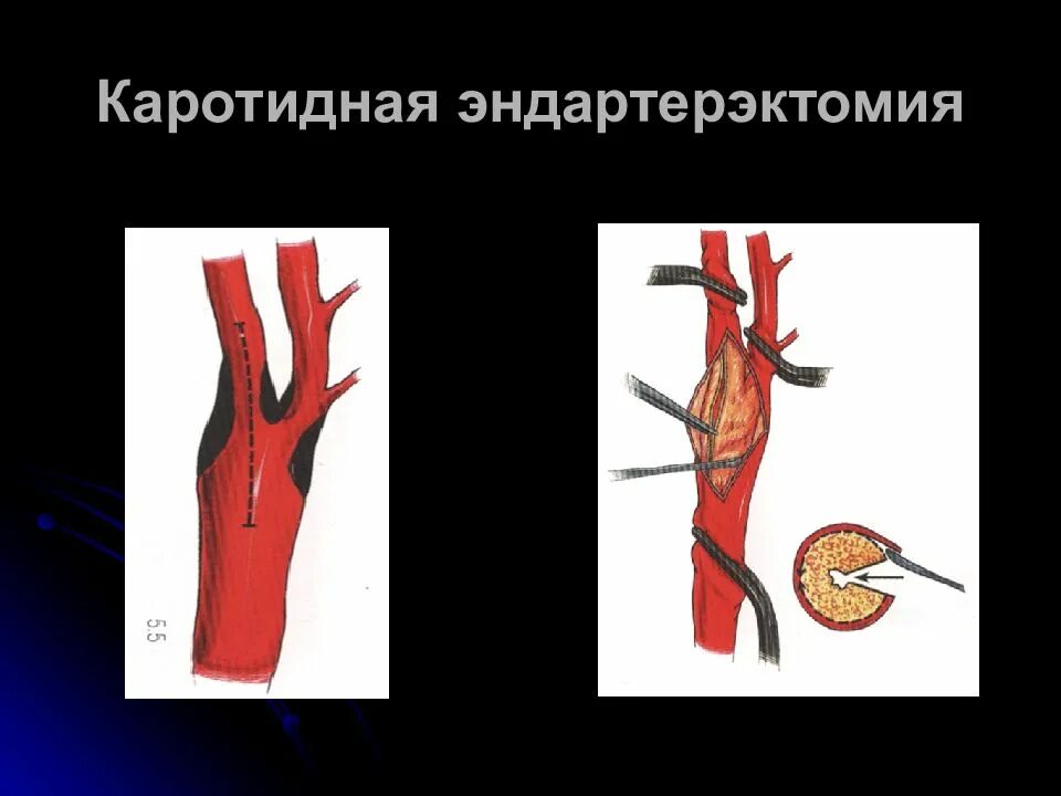 Эндартерэктомия сонной артерии. Эверсионная эндартерэктомия. Каротидная тромбэндартерэктомия. Эверсионная каротидная. Эндартерэктомия это