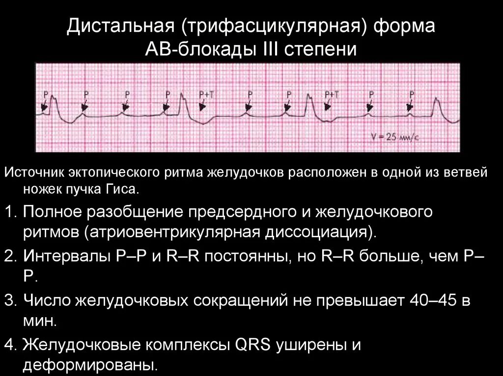 Полная атриовентрикулярная блокада. АВ блокада 3 степени проксимальный и дистальный. Полная атриовентрикулярная блокада 3 степени на ЭКГ. АВ блокада 3 степени проксимальный Тип. АВ блокада 3 степени на ЭКГ дистальная.