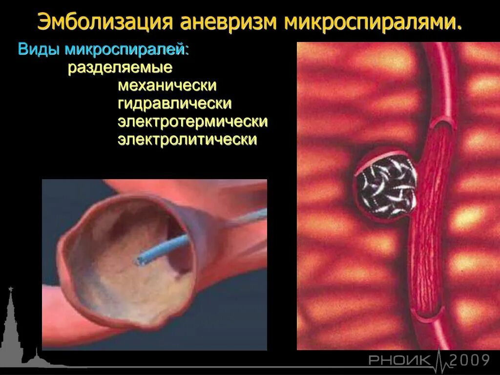 Аневризма головного мозга эндоваскулярным. Эмболизация мешотчатой аневризмы. Эндоваскулярная эмболизация сосудов. Эндоваскулярная эмболизация сосудов головного мозга. Эндоваскулярная хирургия аневризмы головного мозга.