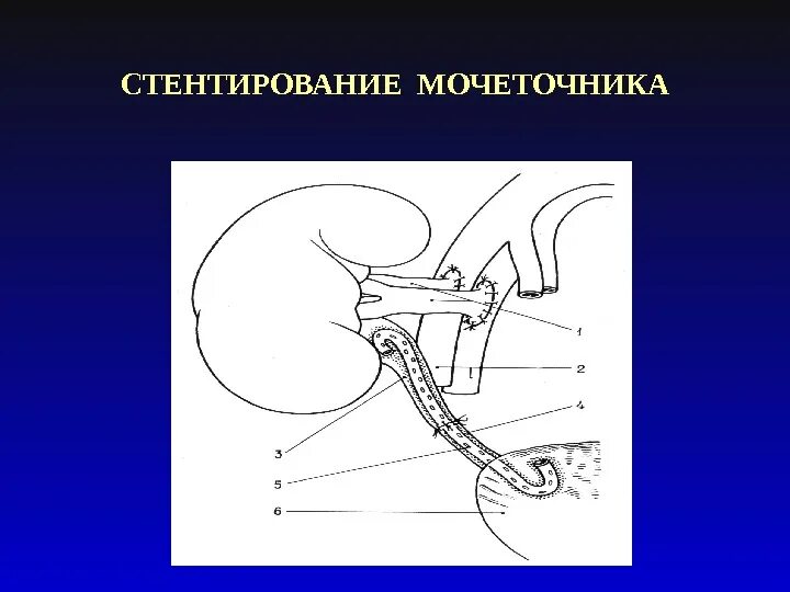 Стент мочеточника отзывы. Стентирование мочеточника. Стентирование мочеточника стентирование мочеточника. Катетер стент мочеточниковый.