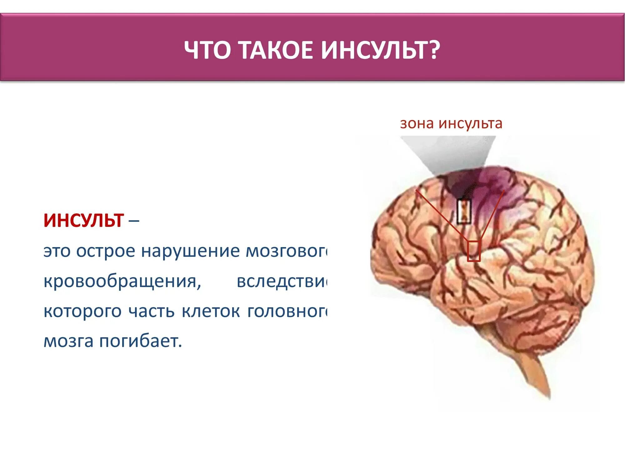 Если у человека был инсульт. Инсульт. Исудьт. Инсульт картинки. Инсульт это простыми словами.