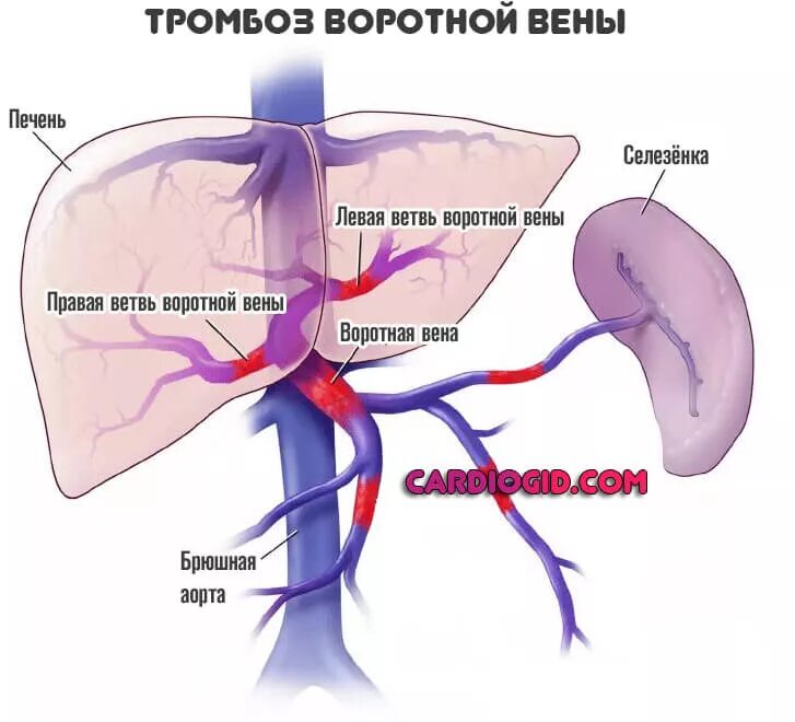 Тромбоз селезеночной вены на кт. Острый тромбоз воротной вены клиника. Флебит воротной вены кт. Какая вена в печени