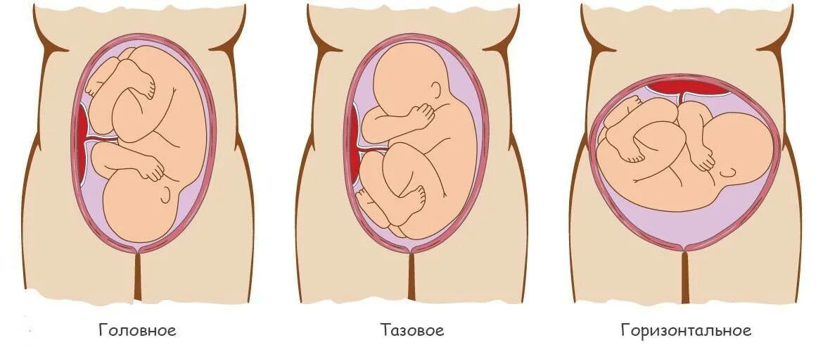 Предлежание головой. Головное и тазовое предлежание плода. Головковое предлежание плода. Головное предлежание плода при беременности. Головное предлежание плода на 23 неделе беременности.