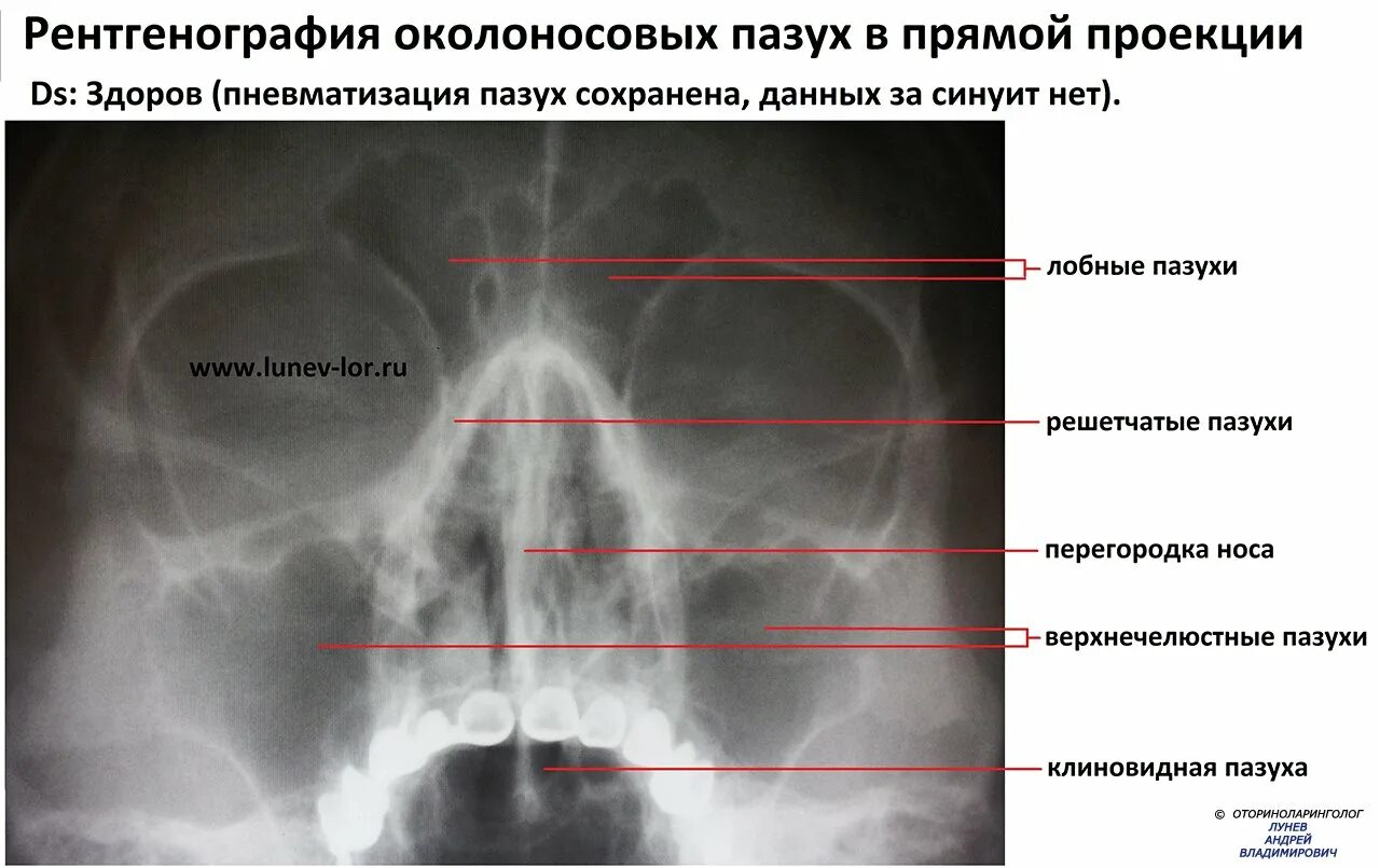 Лор левый берег. Придаточные пазухи носа рентген норма. Рентгенография придаточных пазух носа норма. Рентгеновский снимок пазух носа в норме. Рентгеновский снимок носовых пазух норма.