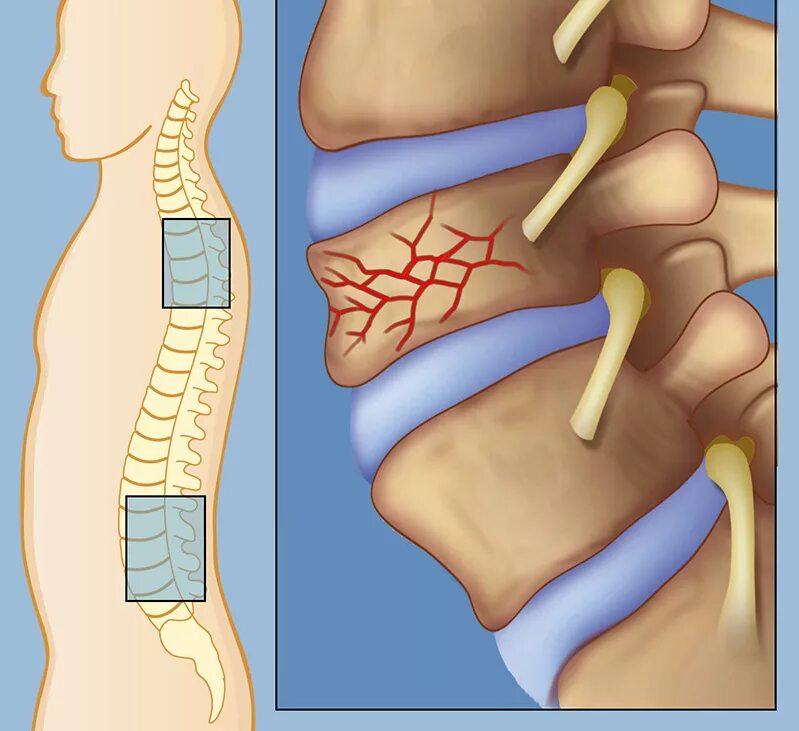 Компрессионный перелом позвоночника т12. Компрессионный перелом т12 позвонка позвоночника. Компрессионный перелом позвоночника th11-l1. Компрессионные переломы l2,l3,l4.