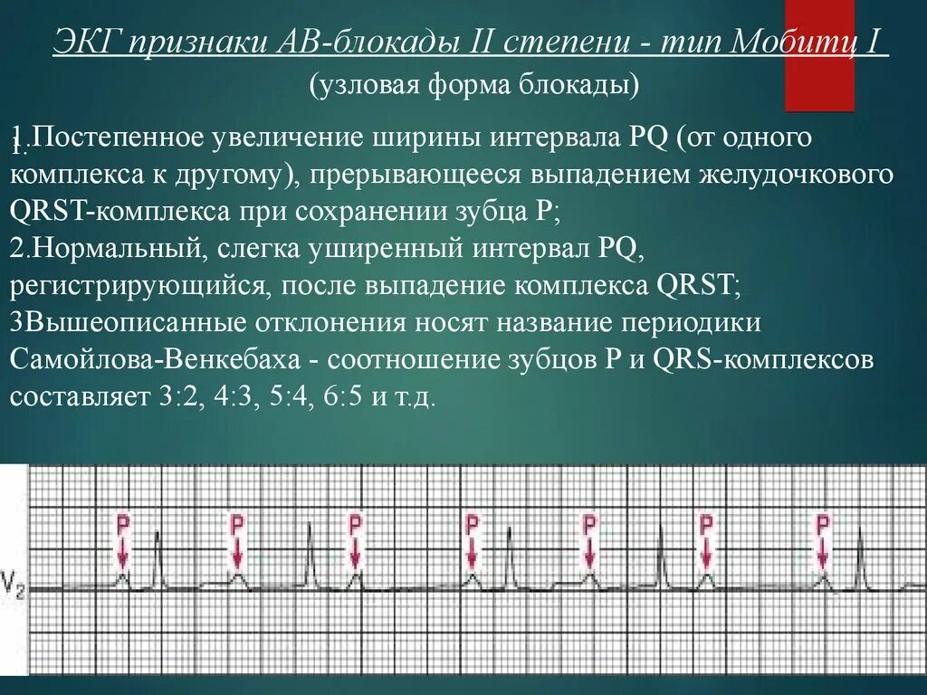 Атриовентрикулярная блокада признаки. ЭКГ признаки АВ блокады 2 степени Мобитц 2. ЭКГ критерии АВ блокады 2 степени Мобитц 2. Av блокада 2 степени Мобитц 2 симптомы ЭКГ. ЭКГ критерии АВ блокады 1 степени.