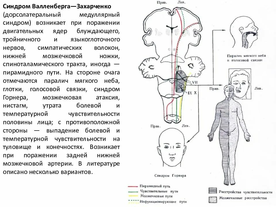Альтернирующий синдром Валленберга-Захарченко. Альтернирующий синдром Валленберга-Захарченко неврология. Синдром Валленберга Захарченко схема. Альтернирующий синдром Валленберга-Захарченко очаг поражения. Лев гемипарез
