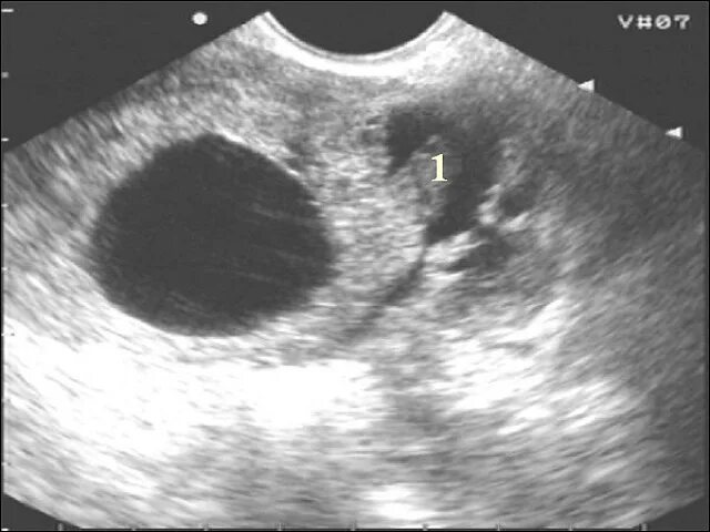 Внематочная беременность 5-6 недель УЗИ. Внематочная беременность 6 недель УЗИ. Гидатида маточной трубы на УЗИ. Можно перепутать беременность с кистой