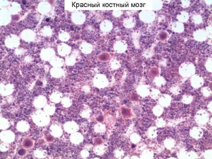 Заполнена красным костным мозгом. Красный костный мозг гистология препарат. Желтый костный мозг гистология. Строение красного костного мозга гистология. Плазмоцитома гистология.