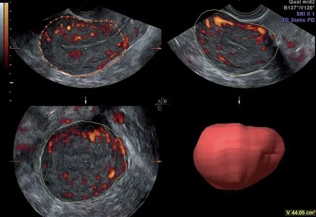 Признаки внутреннего эндометриоза на узи. Диффузный эндометриоз матки УЗИ. Аденомиоз очаговая форма.