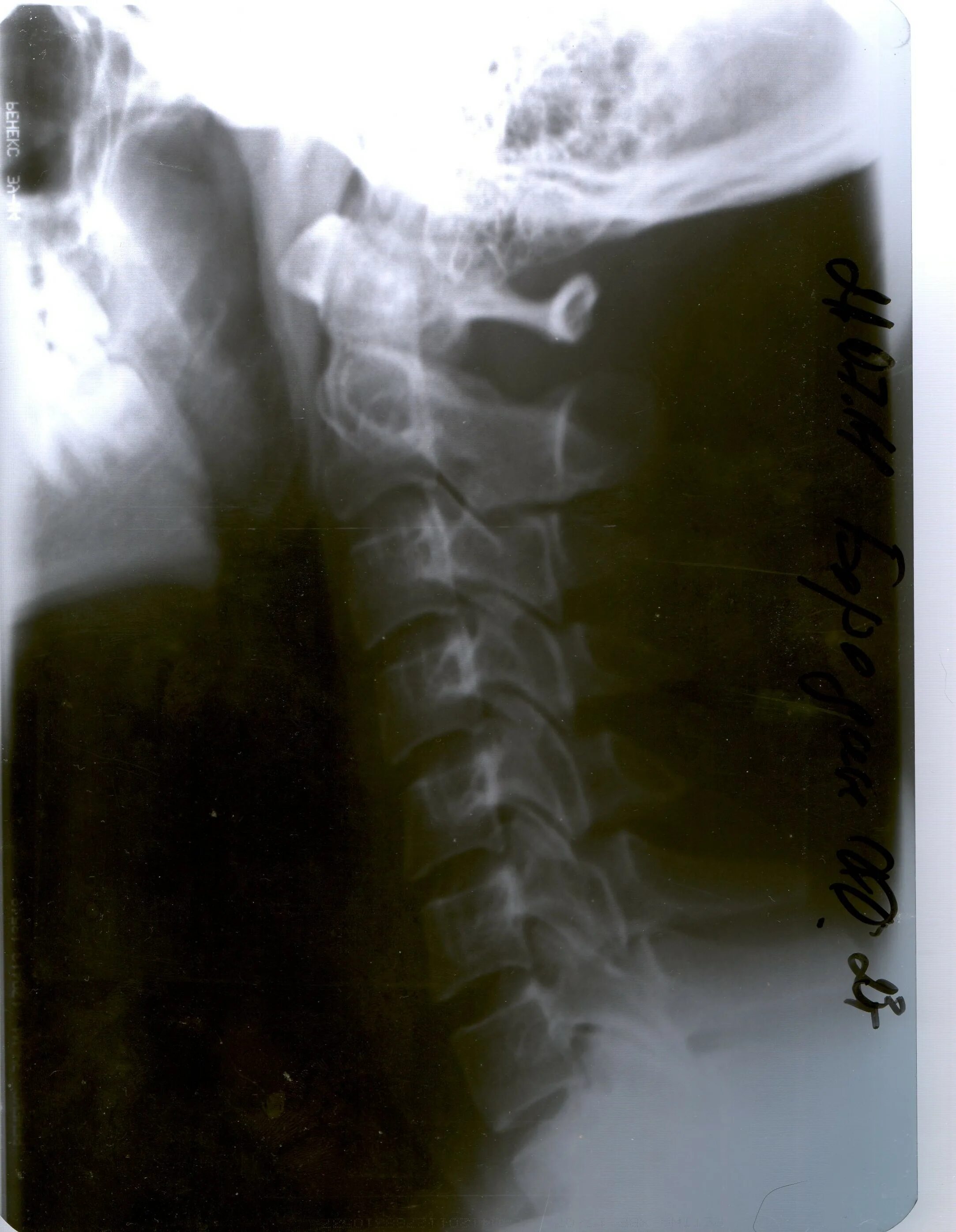 Нестабильность с1. Нестабильность шоп с3-с4 с4-с5. Нестабильность шоп с3-с4 с4-с5. Нестабильность с1. Задний спондилодез.