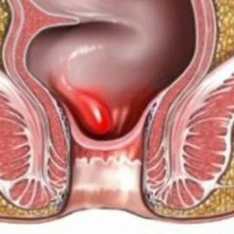 Трещина болит. Геморроидальное кровотечение. Анальное отверстие у женщин.