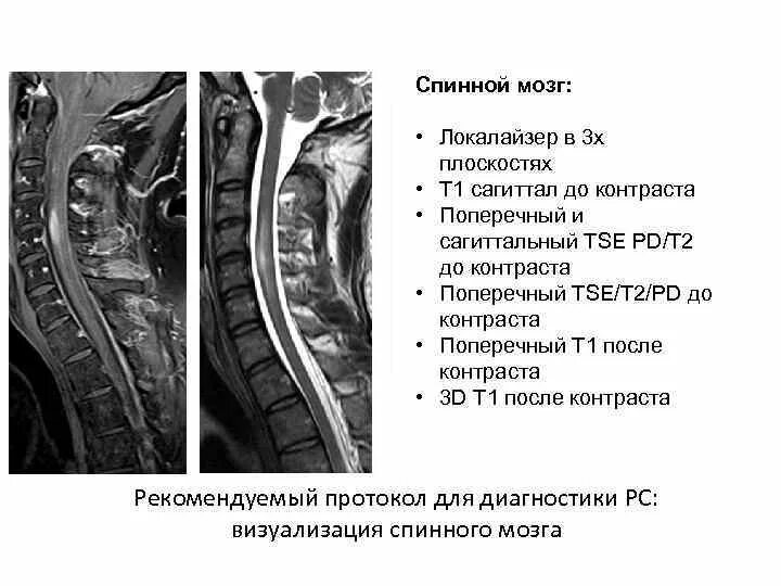 Серые столбы спинного мозга. Поперечный миелит спинного мозга мрт. Центральный канал шейного отдела спинного мозга мрт. Очаги демиелинизации спинной мозг мрт. Демиелинизирующее поражение спинного мозга мрт.