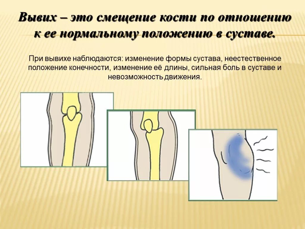 Изменение формы сустава. Вывихи суставов презентация.