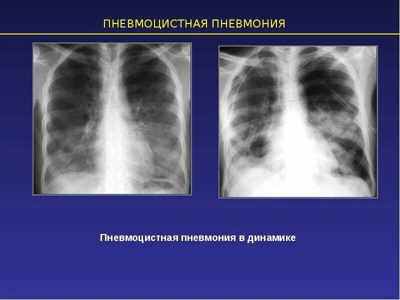 Лучевые заболевания легких. Пневмоцистная пневмония на рентгенограмме. Рентген картина пневмоцистной пневмонии. Пневмоцистная пневмония рентгенологически. Пневмоцистная пневмония ОАК.