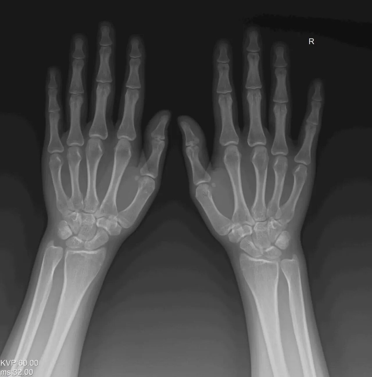 Зоны роста костей на рентгене. Открытые зоны роста на рентгене. Зоны роста на рентгене кисти. Закрытые зоны роста.