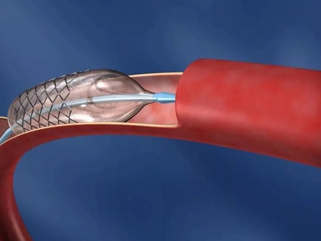 Коронарное стентирование. Стент для коронарных артерий. Операция стентирование сосудов сердца. Стент коронарный коммандер. Ангиопластика цена