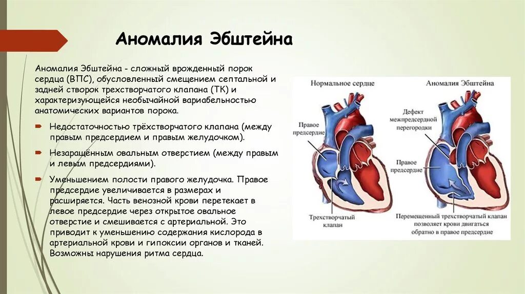 Аномалия Эбштейна сердца врожденный порок сердца. Врожденный порок сердца Эпштейна. Аномалия Эбштейна сердца клинические рекомендации. Порок сердца синдром Эпштейна.