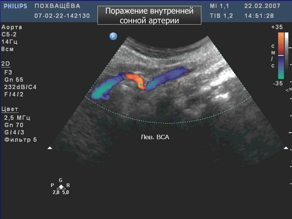 Изгиб вса. С-образная извитость внутренней сонной артерии. Извитость позвоночных артерий УЗИ. Внутренняя Сонная артерия на УЗИ. S образная извитость сонной артерии.