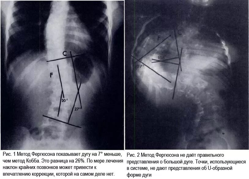 Угол Кобба степени сколиоза. Угол сколиотической деформации. Измерение сколиоза рентген. Сколиоз по коббу степени рентген. Угол кобба
