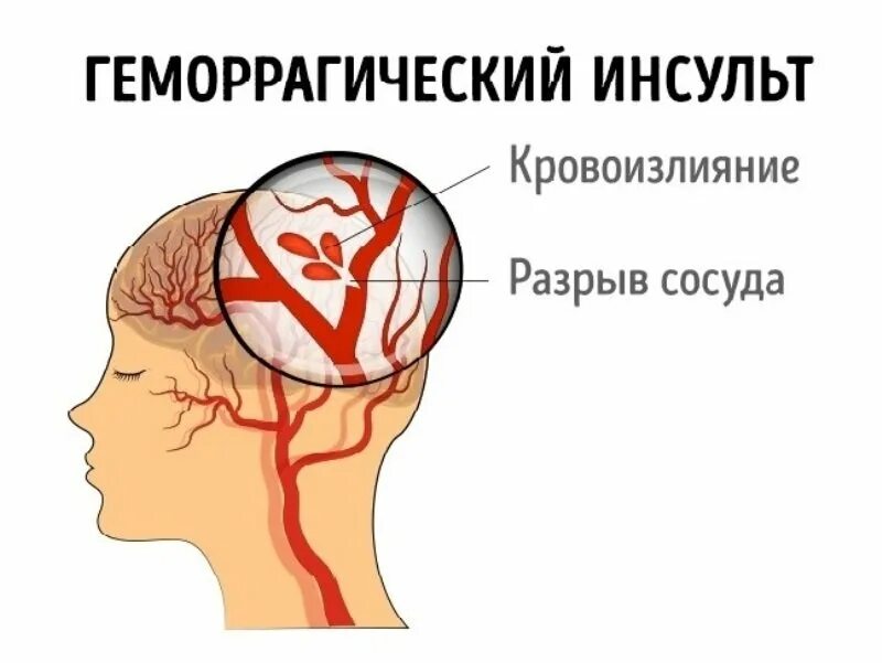 Инсульт правая сторона мозга последствия. Геморрагический инсульт. Геморрагический инсульт кровоизлияние. Геморрагический инсульт разрыв сосуда.