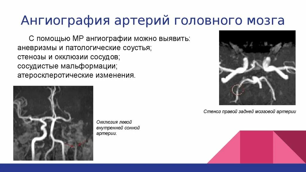 Сосуды головного мозга норма. Мрт головного мозга с ангиографией. Протокол кт-ангиографии сосудов мозга. Магнитно-резонансная ангиография сосудов головного мозга. Кт ангиография аневризма головного мозга.