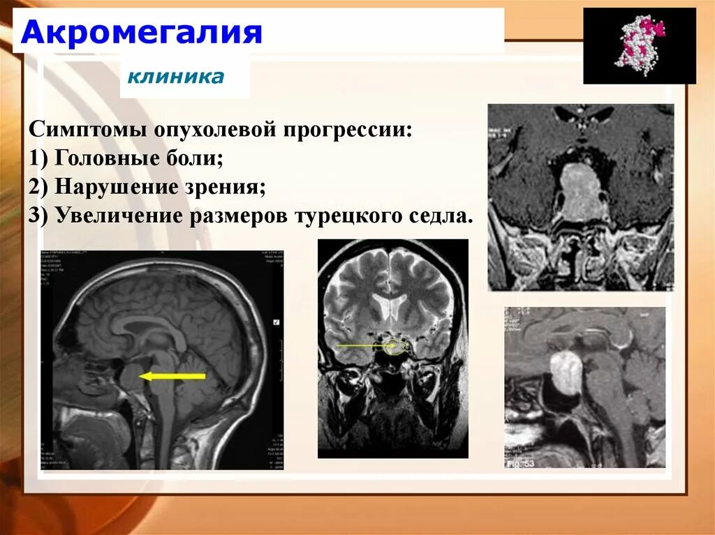 Изменения гипофизе. Аденома гипофиза акромегалия. Аденома гипофиза патология. Соматотропинома гипофиза. Акромегалия мрт гипофиза.