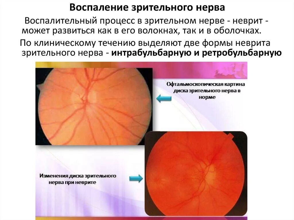 Интрабульбарный неврит зрительного нерва. Оптический неврит папиллит. Неврит зрительного нерва офтальмоскопия. Неврит зрительного нерва глазное дно. Тип зрительного нерва