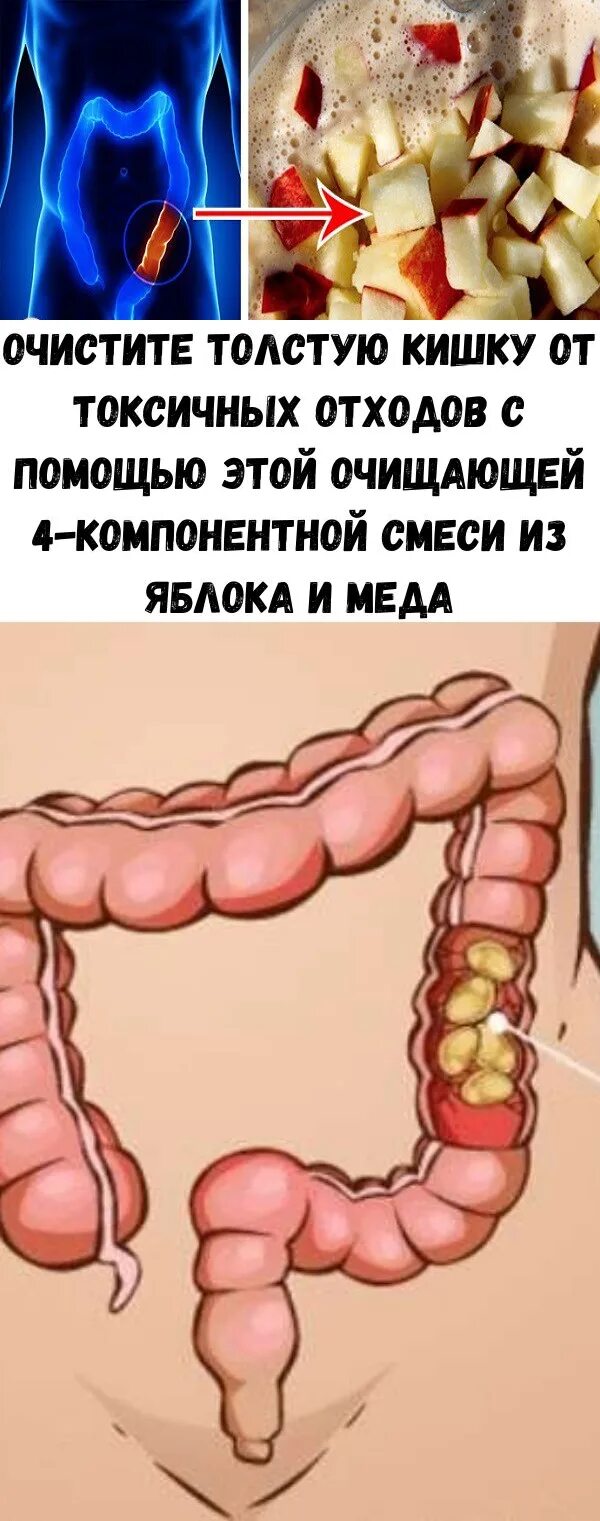 Что можно есть после удаления толстой кишки. Очищение толстой кишки.