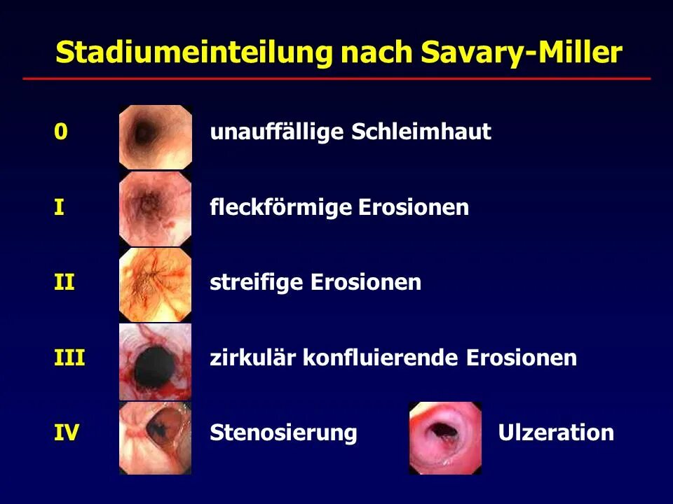 Классификация Савари Миллера ГЭРБ. Классификация Savary-Miller рефлюкс-эзофагита. Классификация ГЭРБ по Savary-Miller. Эрозивный эзофагит Савари Миллер. Эрозивный эзофагит классификация