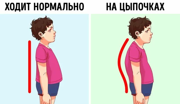 Ходить на цыпочках. Ходьба на цыпочках. Ребенок ходит на цыпочках. Идиопатическая ходьба на цыпочках. Почему человек ходит на носочках