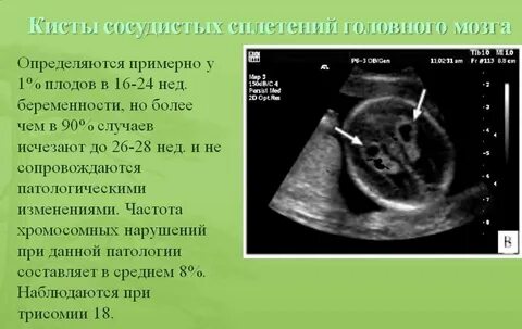 Киста мозга у плода 20 недель