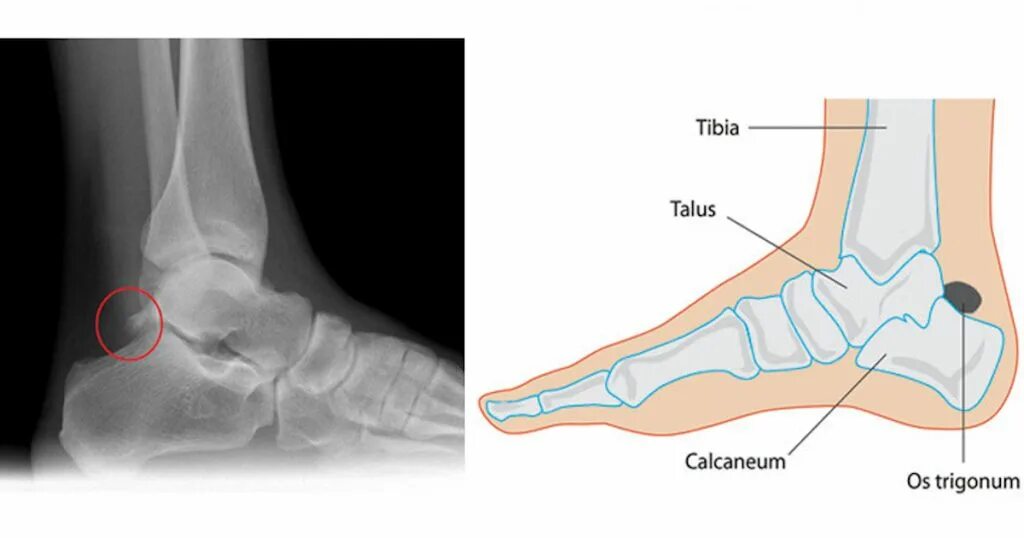 Синдромы голеностопного сустава. Os Trigonum таранной кости. Таранная кость голеностопного сустава. Таранная кость треугольная кость. Os Trigonum таранной кости рентген.