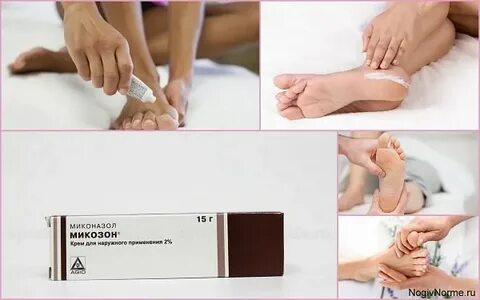 Микозон крем