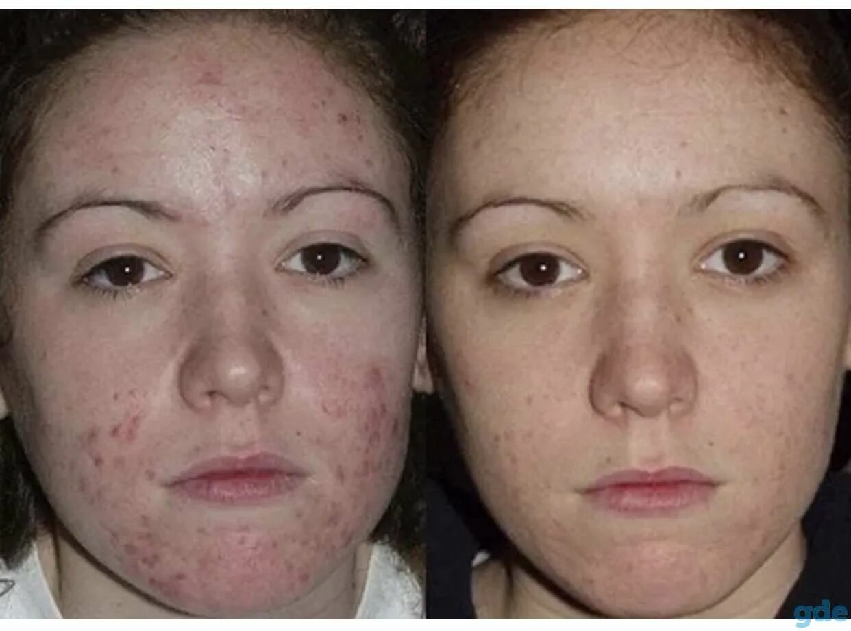 проблемная кожа чистка. проблемная кожа чистка. лицо косметология. лицо девушки с проблемной кожей. подросток и косметология.