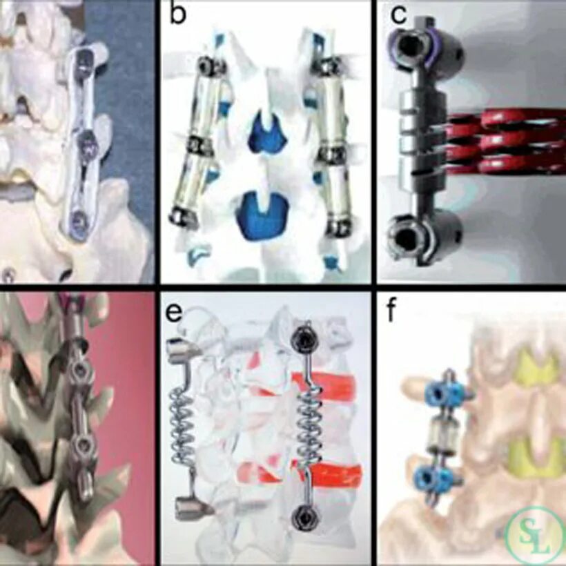 Реабилитация после операции на позвоночнике с металлоконструкций. Спондилодез поясничного отдела позвоночника. Конструкция в позвоночнике. Металлоконструкция в позвоночнике. Металлическая конструкция для позвоночника.