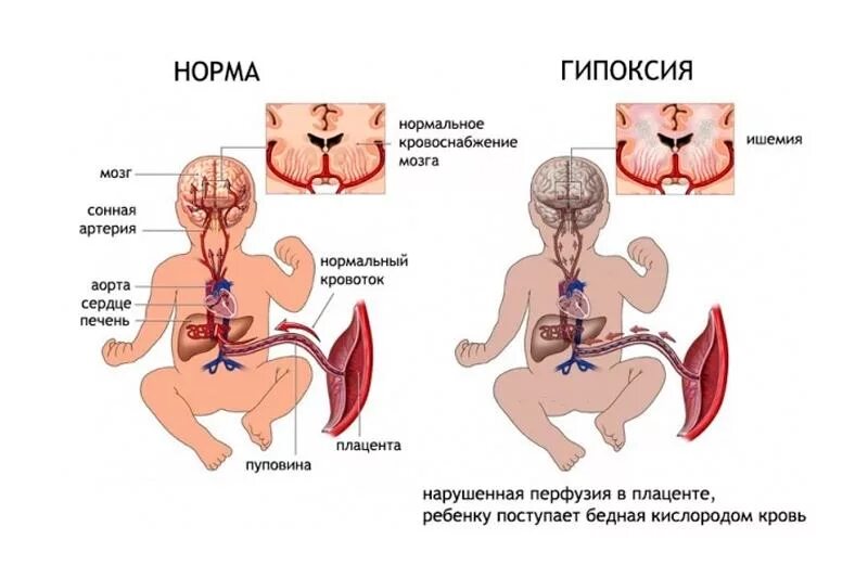 Гипоксия плода при беременности. Кислородное голодание плода. Гипоксия у новорожденных. Симптомы гипоксии у новорожденного.