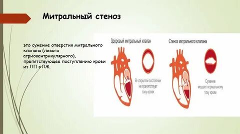 Стеноз отверстия