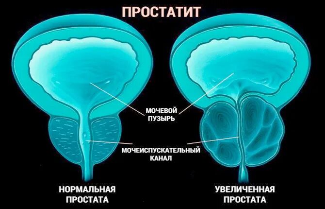 Простатит. Простата нормальная и воспаленная.