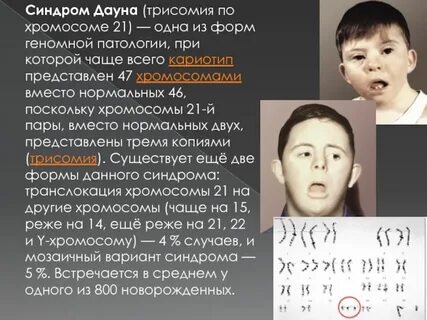 Синдром дауна какая трисомия