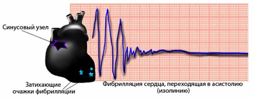 Фибрилляция мышц. Фибрилляция сердца. фибрилляция желудочков сердца. фибрилляция фибрилляция сердца. фибрилляция сердечной мышцы.
