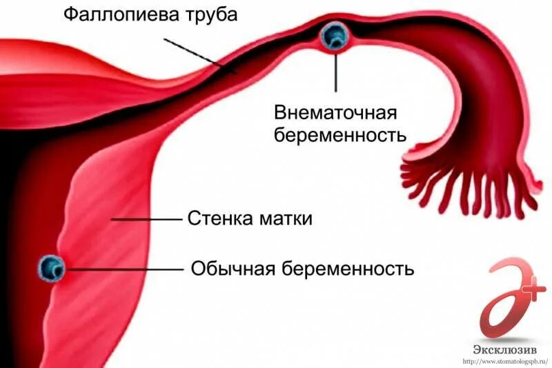 Причины вб. Внематочная Трубная беременность. Внематочная (эктопическая) беременность. Оплодотворение в маточной трубе. Эктопическая Трубная беременность.