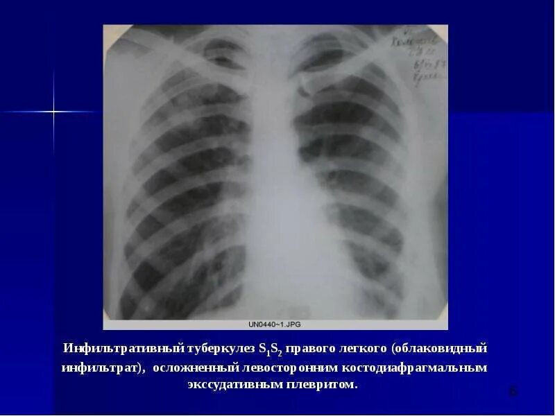 Инфильтративный туберкулез s1-2 левого легкого. Инфильтративный туберкулез s6. Инфильтративный туберкулез s1 s2. Инфильтративный туберкулез s1 s2 МБТ.