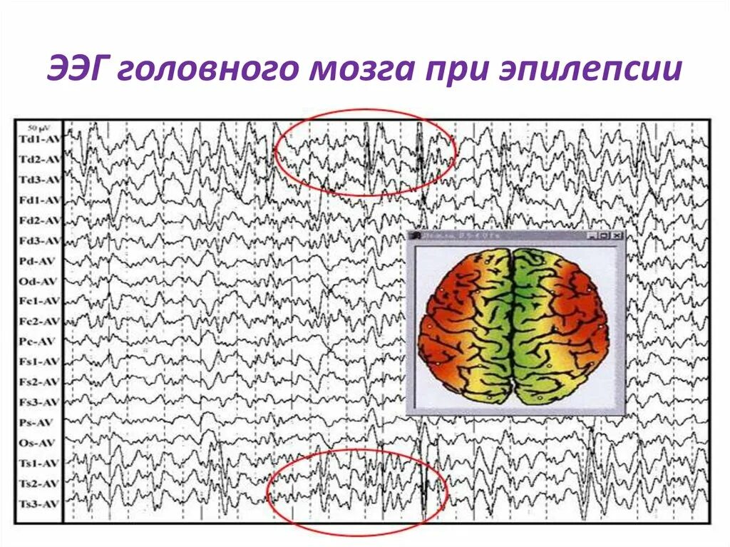 Ээг ответ. Генерализованная эпилепсия ЭЭГ. Электроэнцефалография, норма, ЭЭГ, видеомониторинг ЭЭГ при эпилепсии\. ЭЭГ больного эпилепсией. ЭЭГ здорового человека и эпилептика.